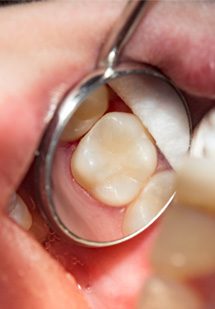 Closeup of a dental filling