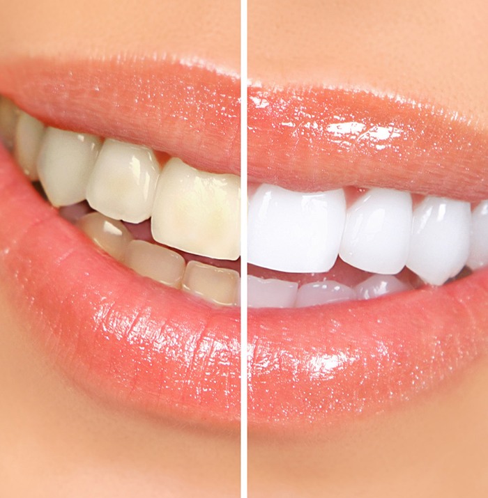 before and after Zoom! teeth whitening in Sugarcreek Township