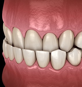 Invisalign may be able to correct your underbite