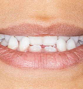 Crossbite can be treated by Invisalign