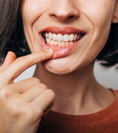 A woman showing her infected gum tissue