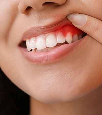 A closeup of a woman’s red and inflamed gums