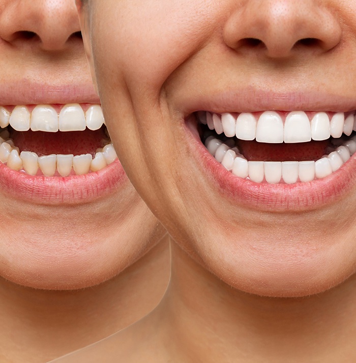 You’ll have plenty of reasons to smile with veneers in Dayton, OH