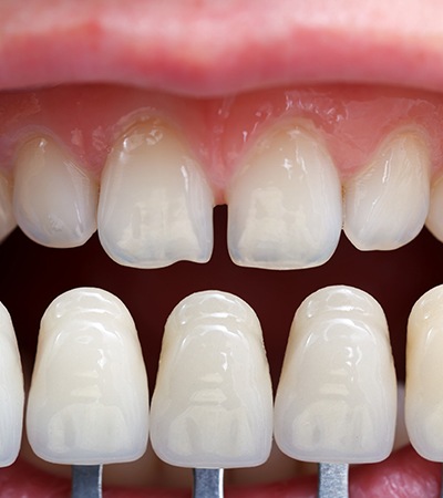 Have a whiter brighter smile in just a few steps with veneers in Dayton OH